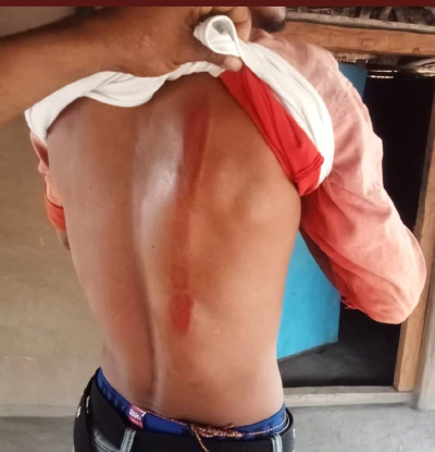 Scar on one of the Christians assaulted in Durandarbha village, Sukma District, Chhattisgarh state, India on April 24, 2025.
