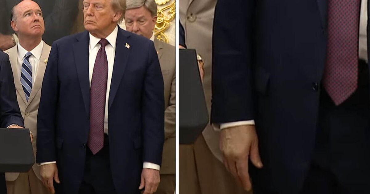 Donald Trump health fears erupt as 'major discoloration' spotted on hand | World | News