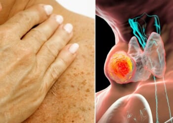 Head and neck cancer warning as lingering cold symptoms could signal disease, doctor warns