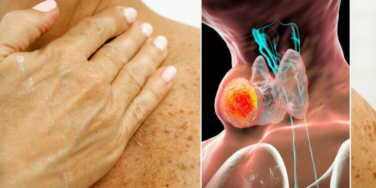 Head and neck cancer warning as lingering cold symptoms could signal disease, doctor warns