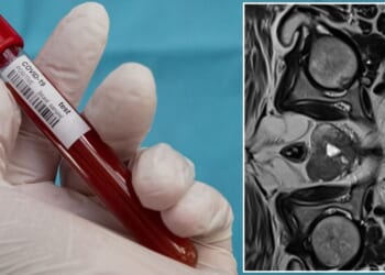 NHS set to deny life-saving prostate cancer checks for most men — putting 1,500 lives at risk