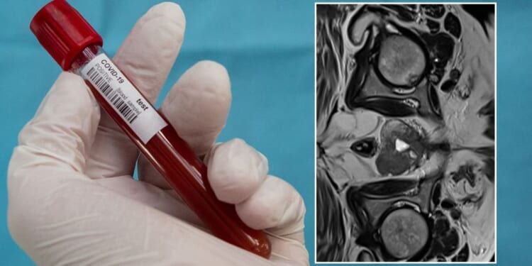 NHS set to deny life-saving prostate cancer checks for most men — putting 1,500 lives at risk