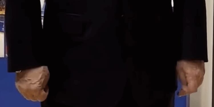 Putin health fears as swollen veins look 'extremely painful' | World | News