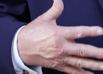 Donald Trump 'paints over black hand' at Zelensky meeting sparks more health fears | World | News