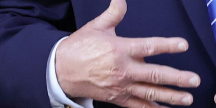 Donald Trump 'paints over black hand' at Zelensky meeting sparks more health fears | World | News