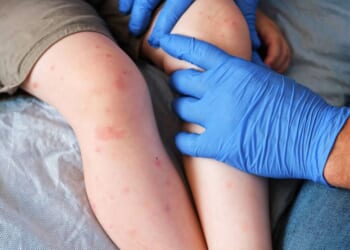Highly contagious disease that was 'eliminated' in UK now 're-established'