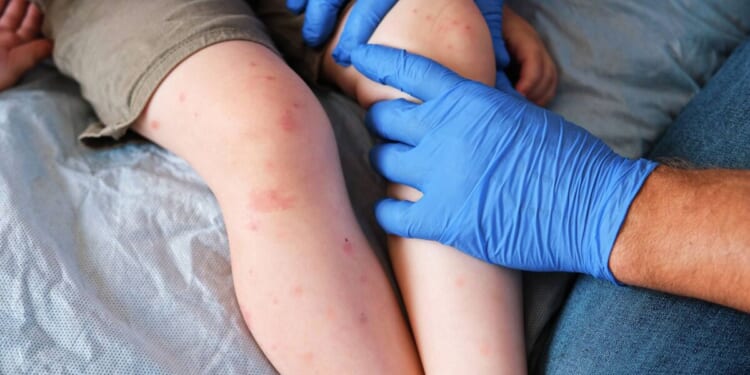 Highly contagious disease that was 'eliminated' in UK now 're-established'