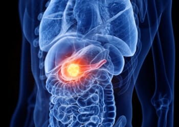 New Therapy Eradicates Pancreatic Tumors In Preclinical Study