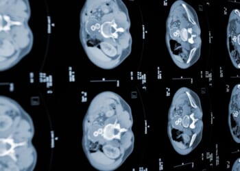 Cancer death rates fall by 11% in a decade as biggest drops revealed by type