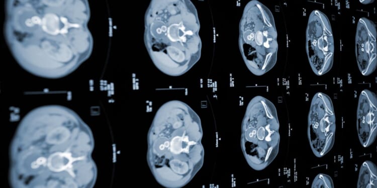 Cancer death rates fall by 11% in a decade as biggest drops revealed by type