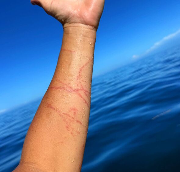 Guy has marks on his arm from the attack